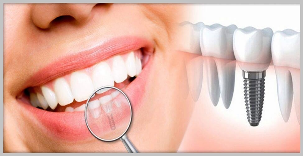 مرکز ایمپلنت اقساطی غرب تهران