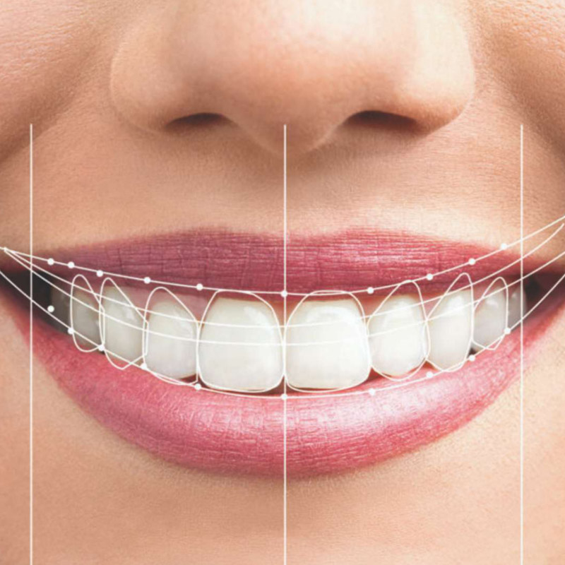 قیمت کامپوزیت طرح لبخند