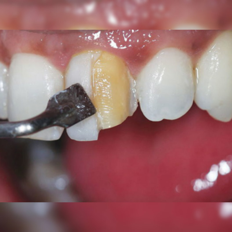 افتادن کامپوزیت دندان