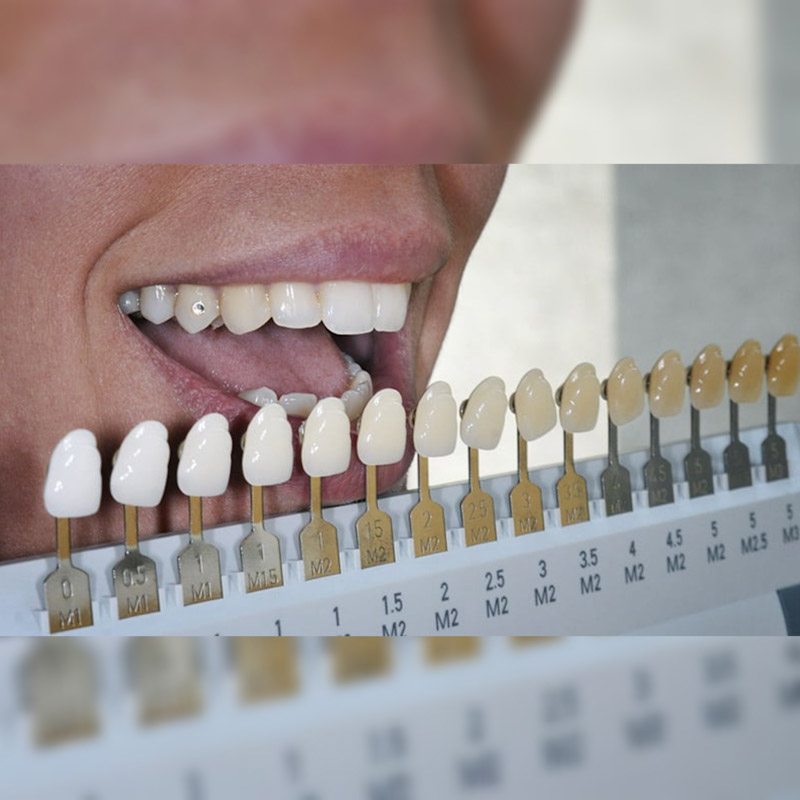 انواع رنگ های کامپوزیت دندان xbw ، bw ، b1 ، a1