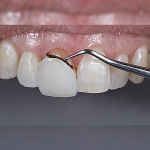 ایا کامپوزیت دندان را میشود برداشت