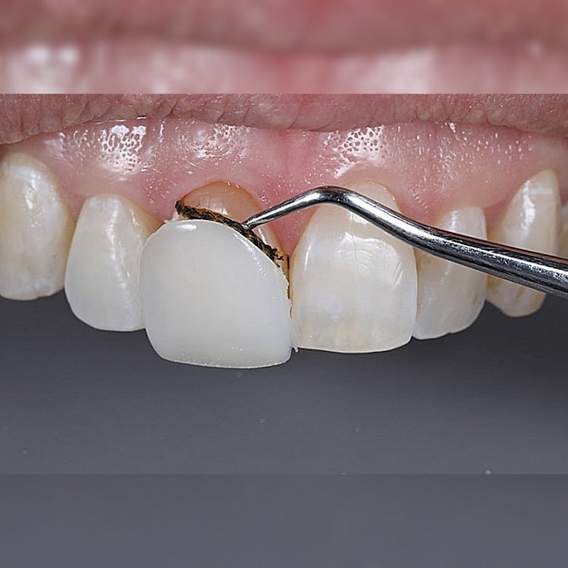 ایا کامپوزیت دندان را میشود برداشت