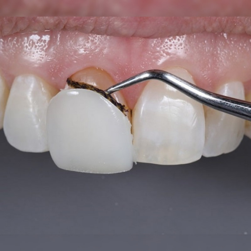 ایا کامپوزیت دندان کنده میشود