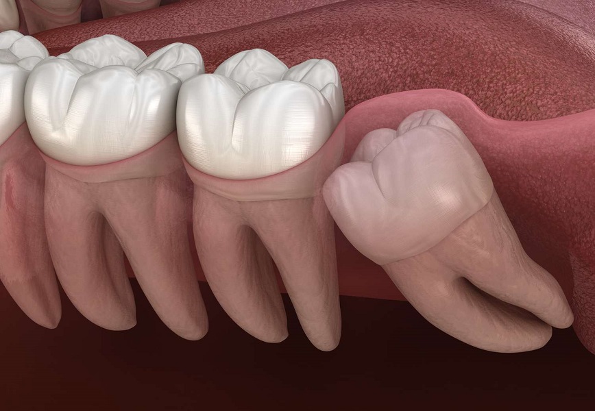 بهترین جراح دندان عقل تهران