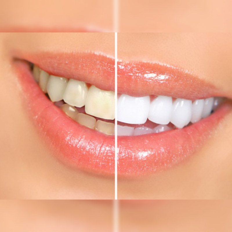 طول عمر کامپوزیت دندان های جلو