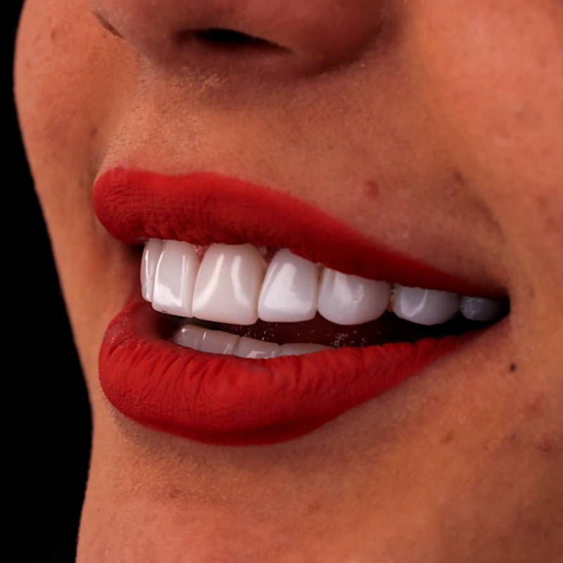 عوارض کامپوزیت دندان های جلو