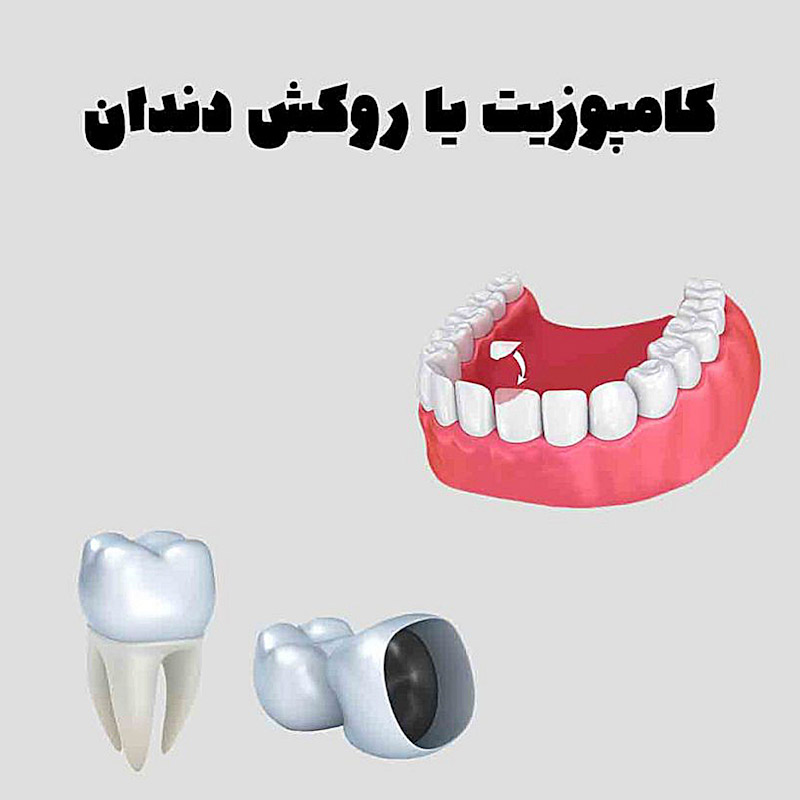 فرق روکش با کامپوزیت