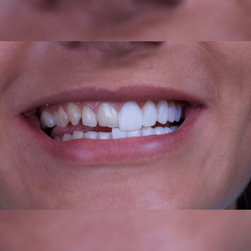 فرق لمینت وکامپوزیت