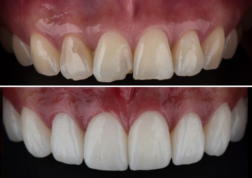 قیمت کامپوزیت دندان در ارومیه