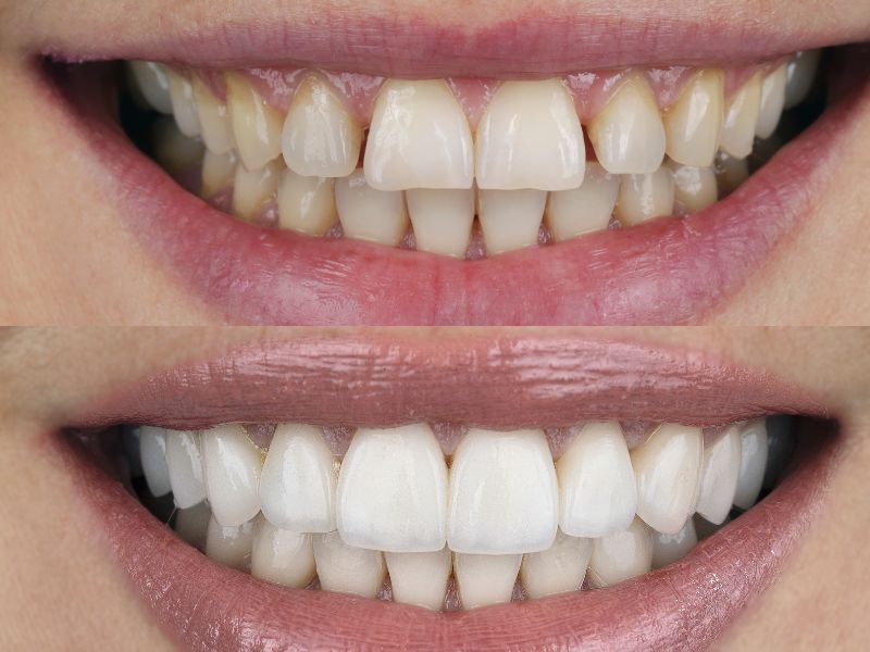 قیمت کامپوزیت دندان در تهران