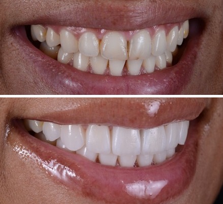 قیمت کامپوزیت دندان در ساری