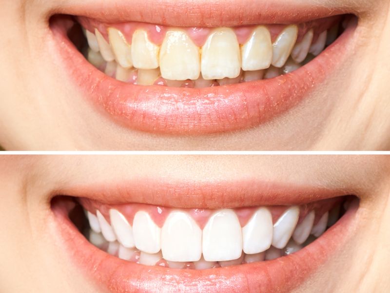 قیمت کامپوزیت دندان در قم