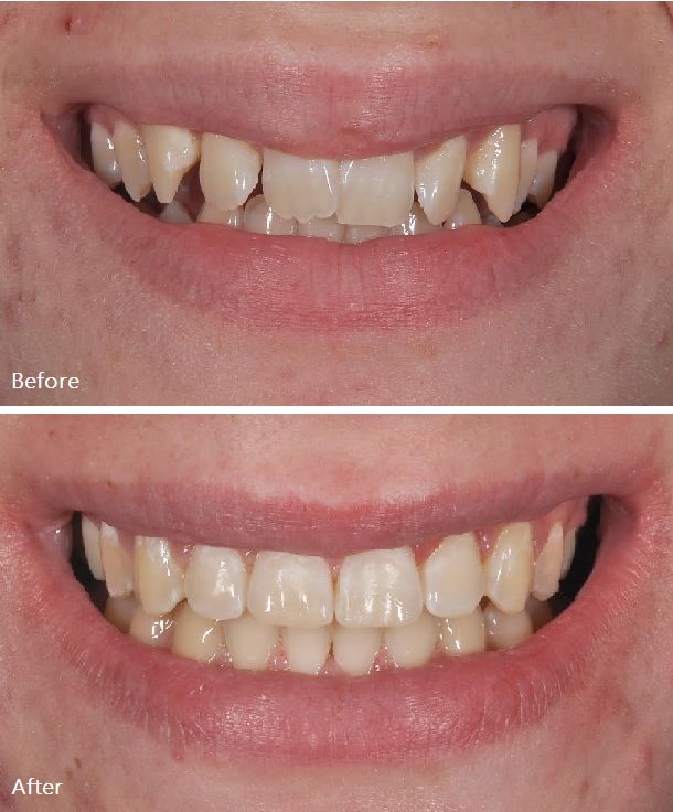 قیمت کامپوزیت دندان در یزد