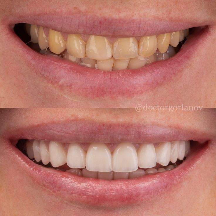 قیمت کامپوزیت دندان قسطی در اراک