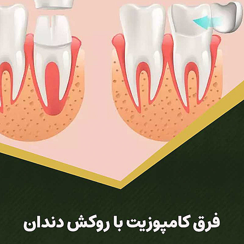 کامپوزیت بهتر است یا روکش دندان