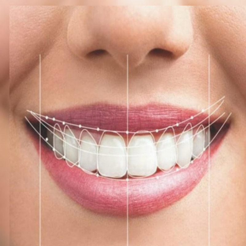 کامپوزیت دندان خرگوشی