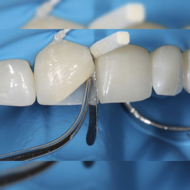 کامپوزیت دندان شکسته جلو