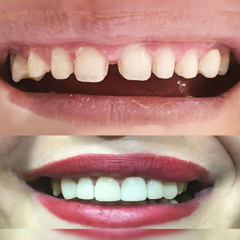 کامپوزیت دندان فاصله دار