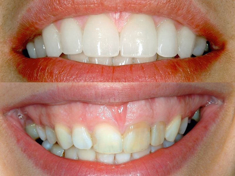 کامپوزیت دندان قسطی در اهواز