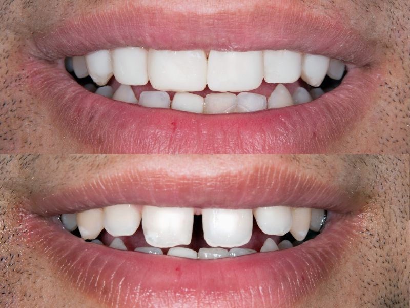 کامپوزیت دندان قسطی در رشت