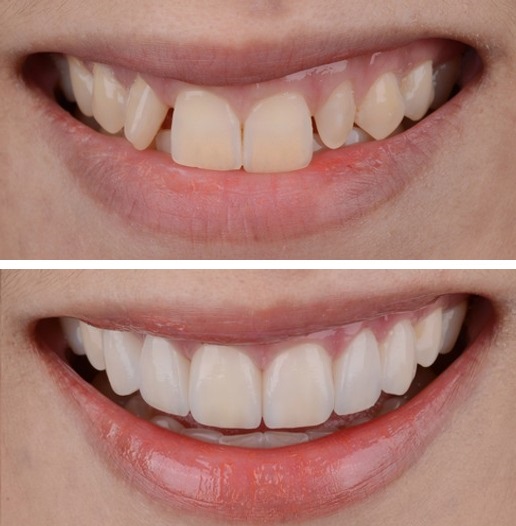 آیا کامپوزیت باعث بوی بد دهان میشود