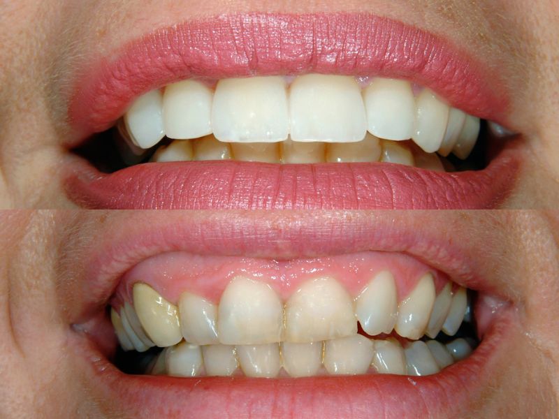 عکس کامپوزیت دندان جلو