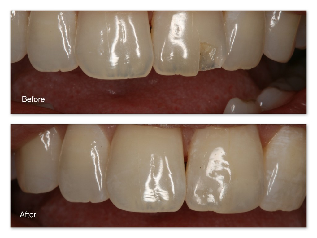 عکس کامپوزیت دندان‌های شکسته یا لب پر شده