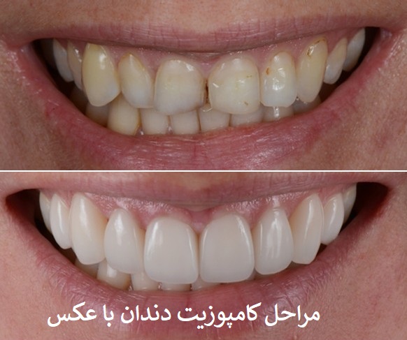 مراحل کامپوزیت دندان با عکس