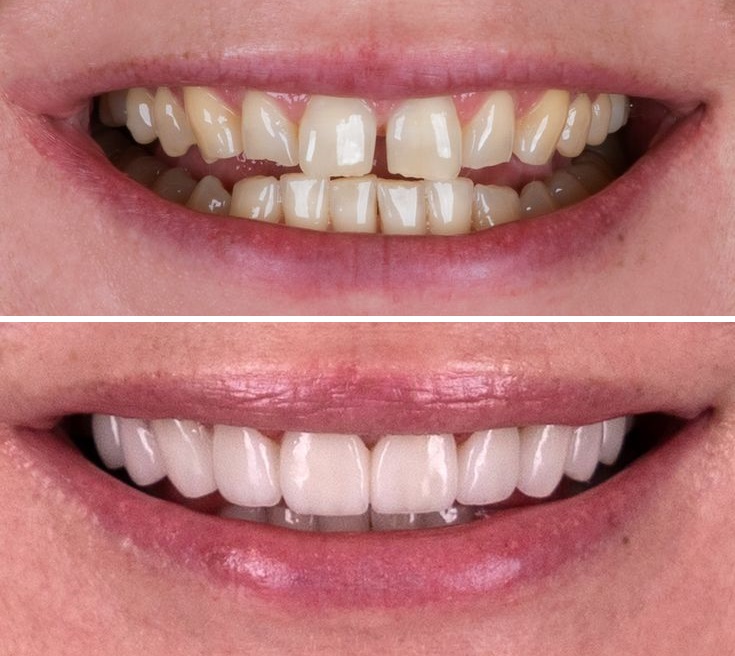 هر واحد کامپوزیت چند دندان است