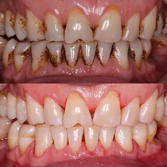 عوارض لمینت دندان