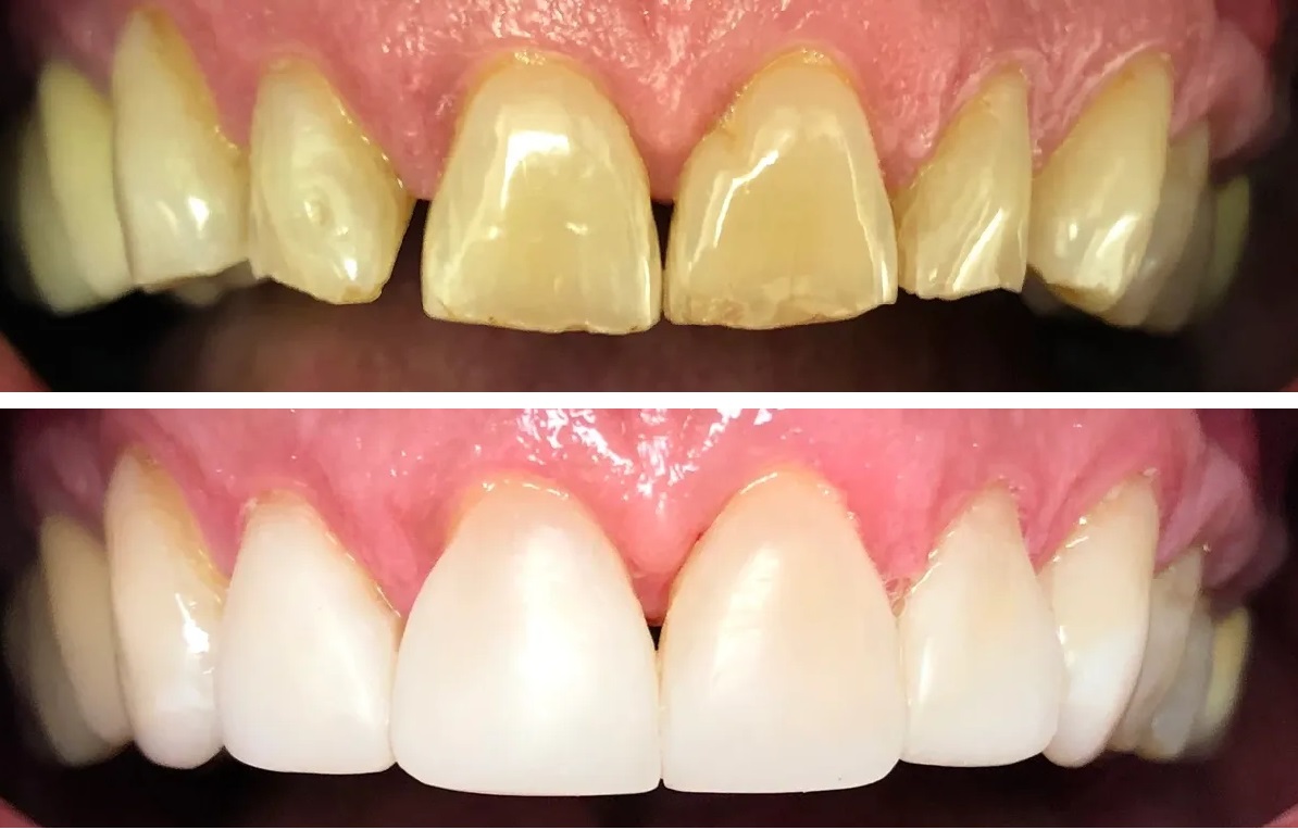 قبل و بعد کامپوزیت کاریزما