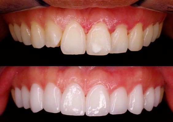 قیمت لمینت دندان ۱۴۰۳