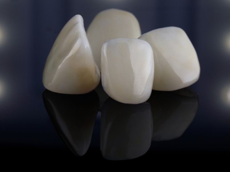 قیمت روکش دندان ۱۴۰۳