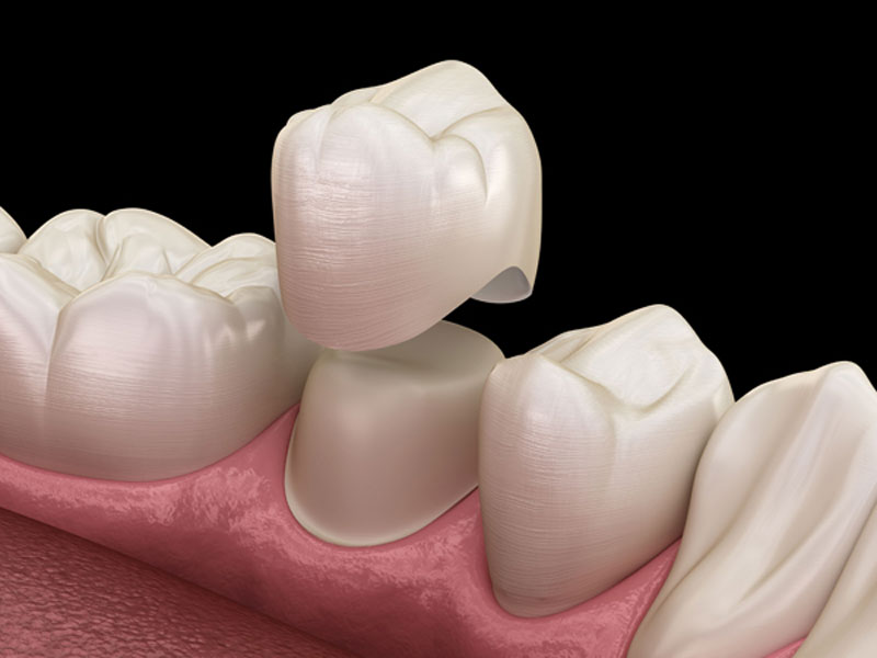 انواع روکش دندان را بشناسید.