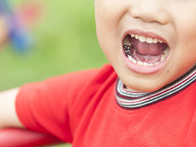 روکش دندان مدل شیری