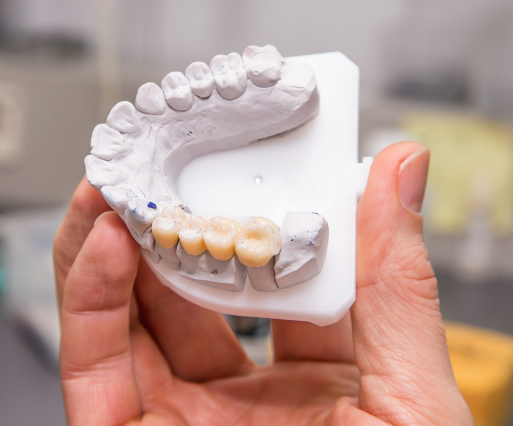 فیلم قالب گیری ایمپلنت