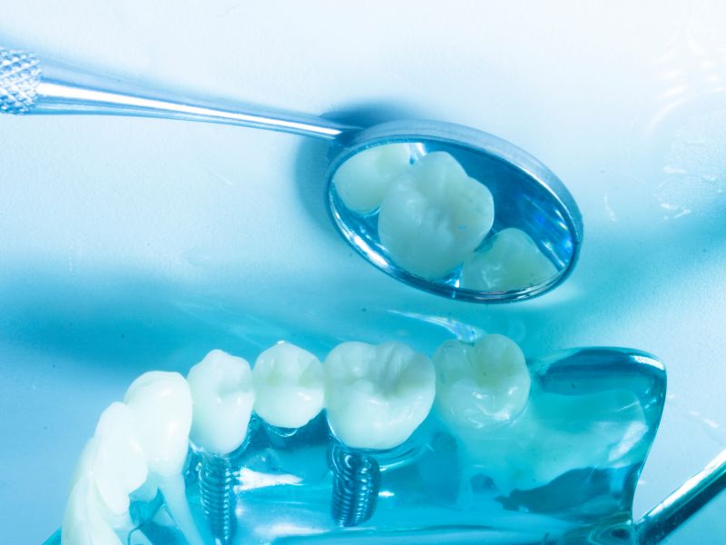 قیمت ایمپلنت دندان ۱۴۰۳