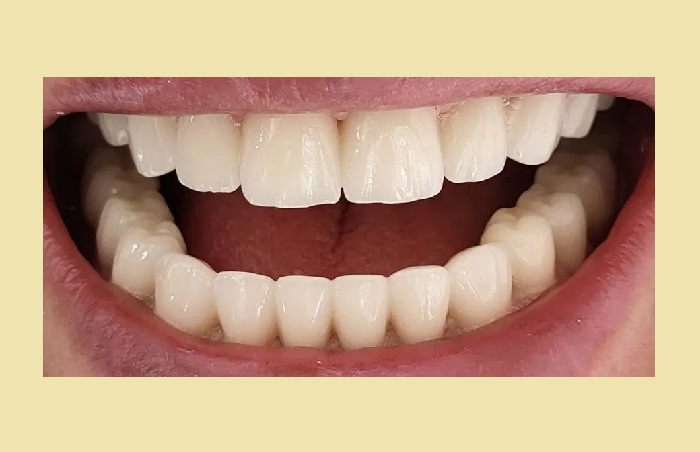 پرکردن دندان با کامپوزیت خوب است یا آمالگ