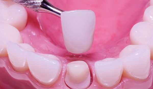 چرا دندان روکش شده درد دارد؟