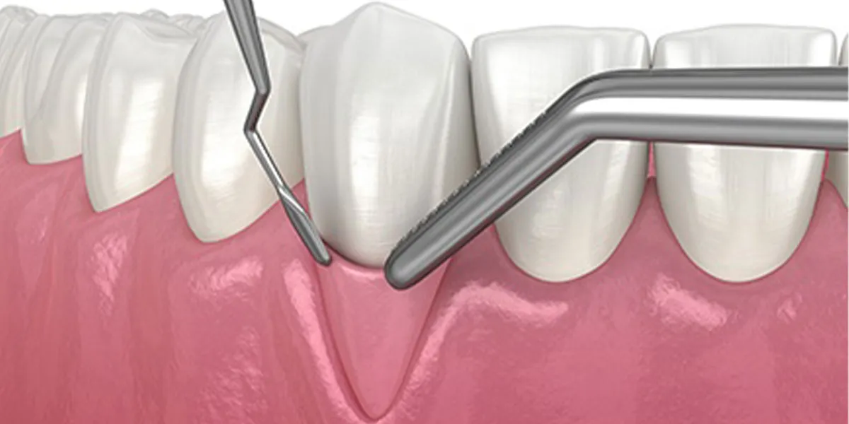 کورتاژ لثه‌ها